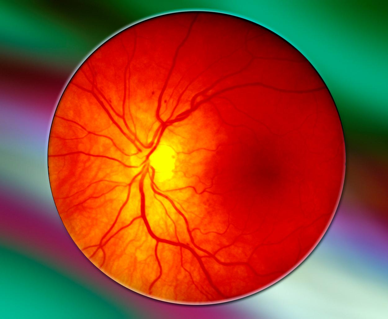 Сетчатки обоих глаз. Пролиферативная диабетическая ретинопатия. Гипертоническая ангиопатия глазное дно. Почечная ангиопатия сетчатки. Постгипоксическая ангиопатия сетчатки.